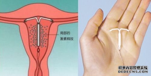 含孕激素的宫内节育器,作用示意图(左)和实物(右) 含孕激素的宫内节育器,作用示意图(左)和实物(右)
