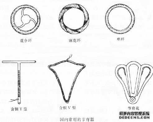 国内常用的节育器 国内常用的节育器