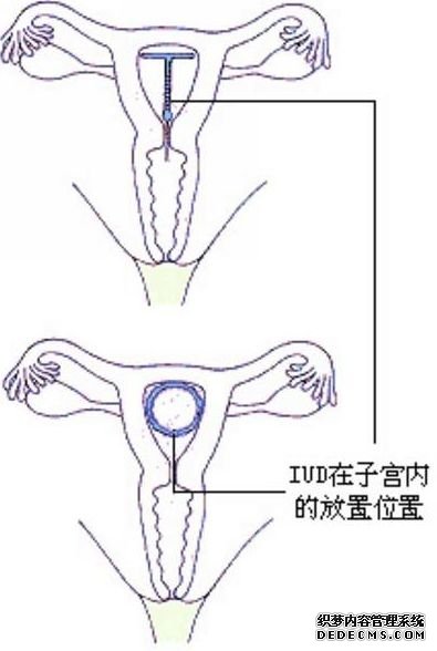 送环入宫腔及安置妥当后示意图 送环入宫腔及安置妥当后示意图