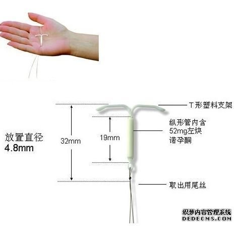 现在广泛使用的“T”型节育器(资料图) 现在广泛使用的“T”型节育器(资料图)