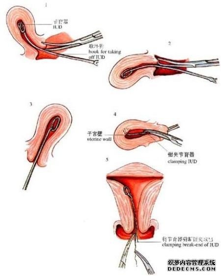 宫内节育器取出(资料图) 宫内节育器取出(资料图)
