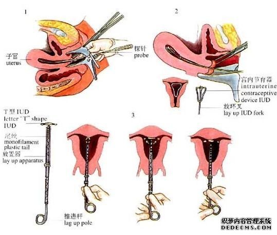 宫内节育器的放置(资料图) 宫内节育器的放置(资料图)