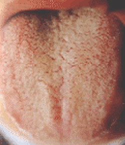 舌苔厚黄 舌苔厚黄