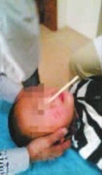 被筷子插伤的孩子接受治疗。 被筷子插伤的孩子接受治疗。