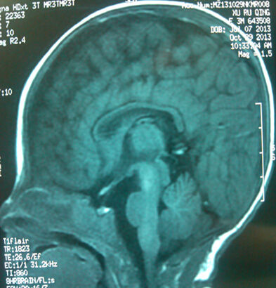 病人的MRI 无胼胝体 病人的MRI 无胼胝体