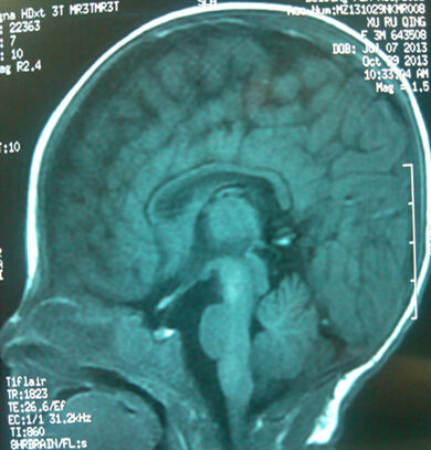 正常儿的MRI,有胼胝体 正常儿的MRI,有胼胝体