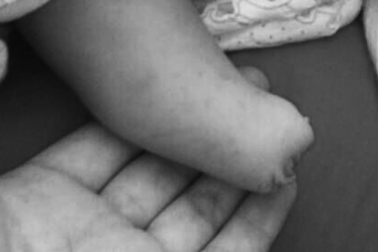 产检做7次B超医生均说正常 孩子出生却没右脚 产检做7次B超医生均说正常 孩子出生却没右脚