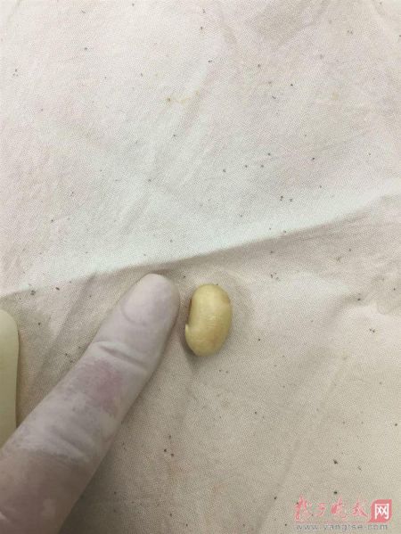 3个月男婴呕吐6天险丧命 竟因3岁姐姐喂的黄豆 3个月男婴呕吐6天险丧命 竟因3岁姐姐喂的黄豆