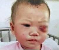 精神病爸戳瞎10个月女儿 精神病爸戳瞎10个月女儿