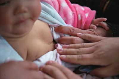 女婴双侧乳房“发育” 女婴双侧乳房“发育”