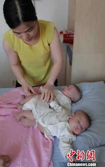连体女婴 连体女婴