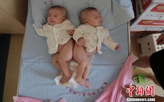 连体女婴 连体女婴