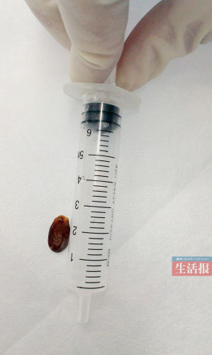 1岁女童春节历险:瓜子卡气管 误诊半个月 1岁女童春节历险:瓜子卡气管 误诊半个月