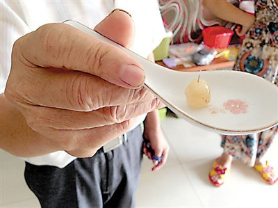 图片说明:2岁女孩吃颗陈皮糖 里面有根硬铁丝 图片说明:2岁女孩吃颗陈皮糖 里面有根硬铁丝