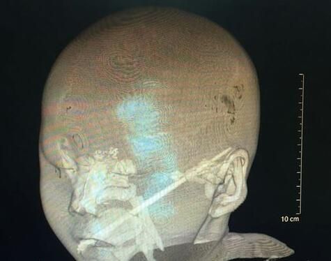 筷子插入2岁宝宝大脑 筷子插入2岁宝宝大脑