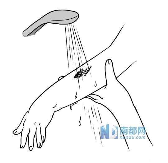 用流水彻底清洗伤口。 用流水彻底清洗伤口。