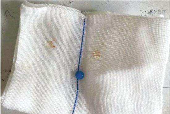 这是从健健耳朵里取出的珠子。 这是从健健耳朵里取出的珠子。