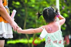 3岁女童婉婉被幼儿园老师烫伤。 3岁女童婉婉被幼儿园老师烫伤。